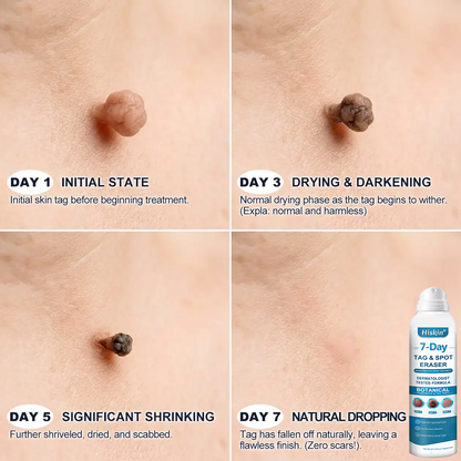 Official Brand Store | ✅💎 Hiskin® 7-Day Tag & Spot Eraser (Zero Pain, Zero Scars Precision Spray)